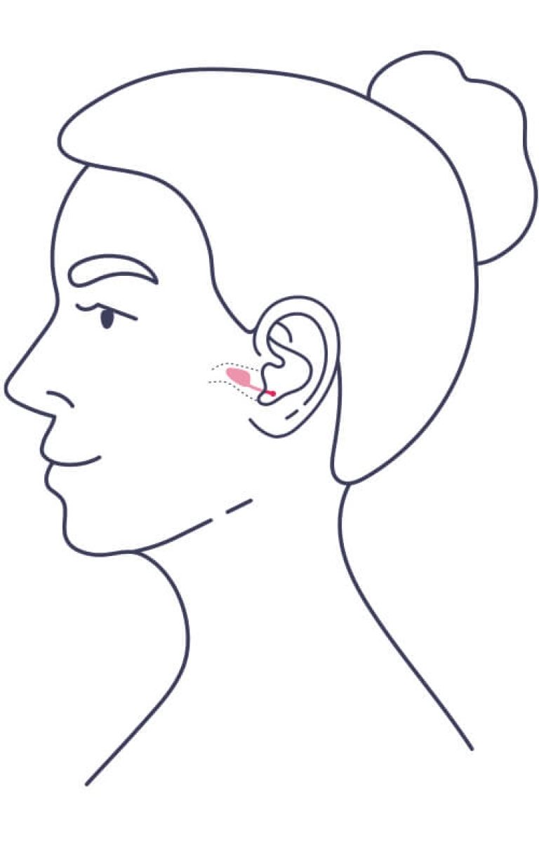 Illustration eines Profils mit einem kleinen Im-Ohr-Hörgerät